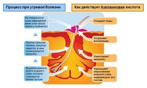 azelainovuyu-kisloti-kosmetologii-3